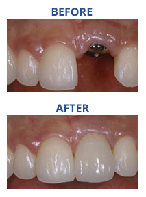 ID_ImplantCrowns