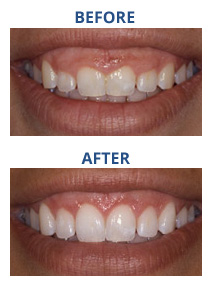 RD_GumTreatment