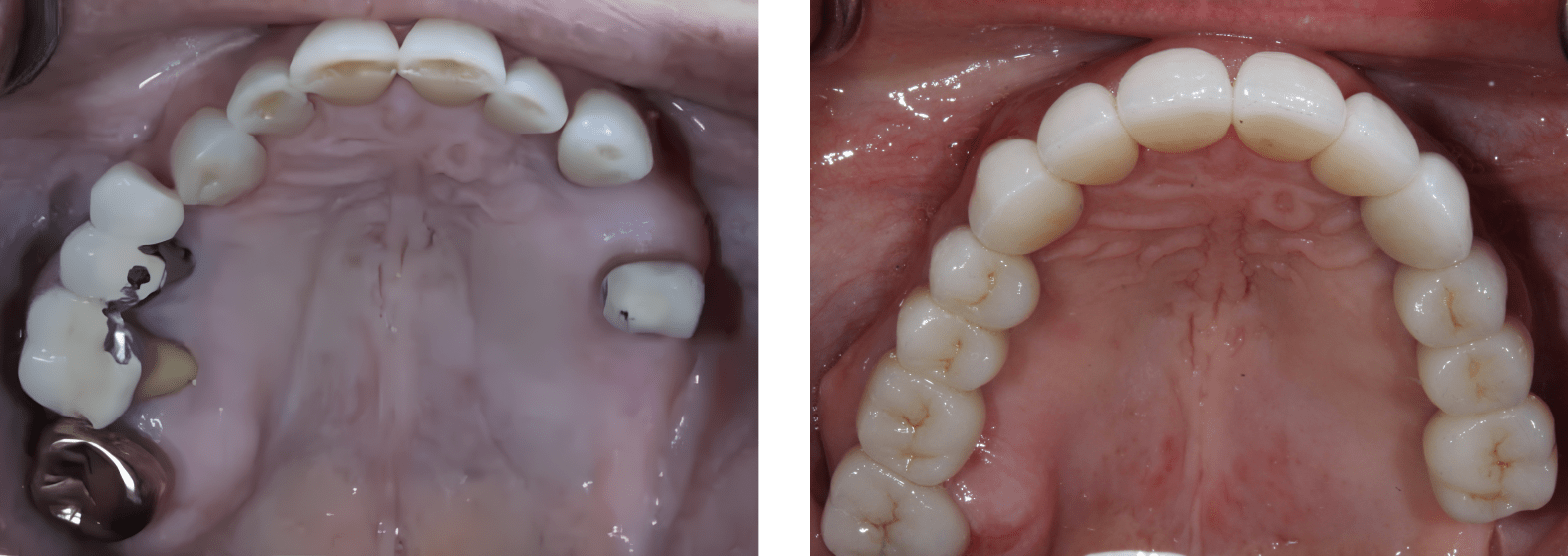 A split screen image of Patient's teeth before treatment