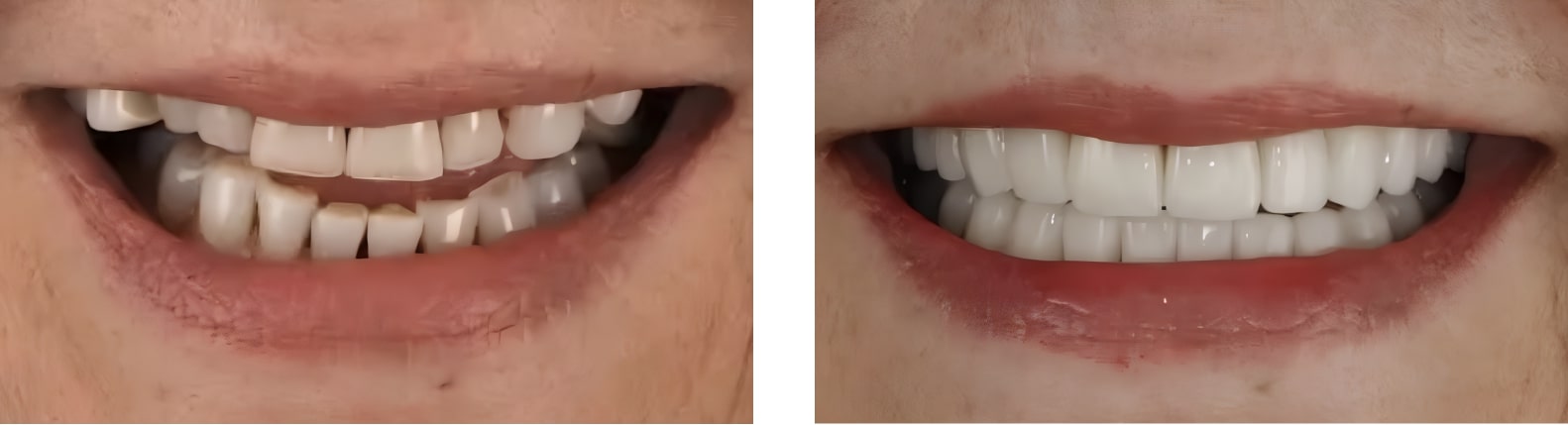 A split screen of the before and after smiles