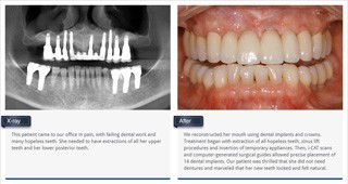 thumb_implant_recon