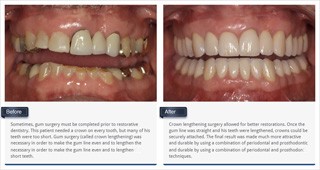 thumb_gum_treatments