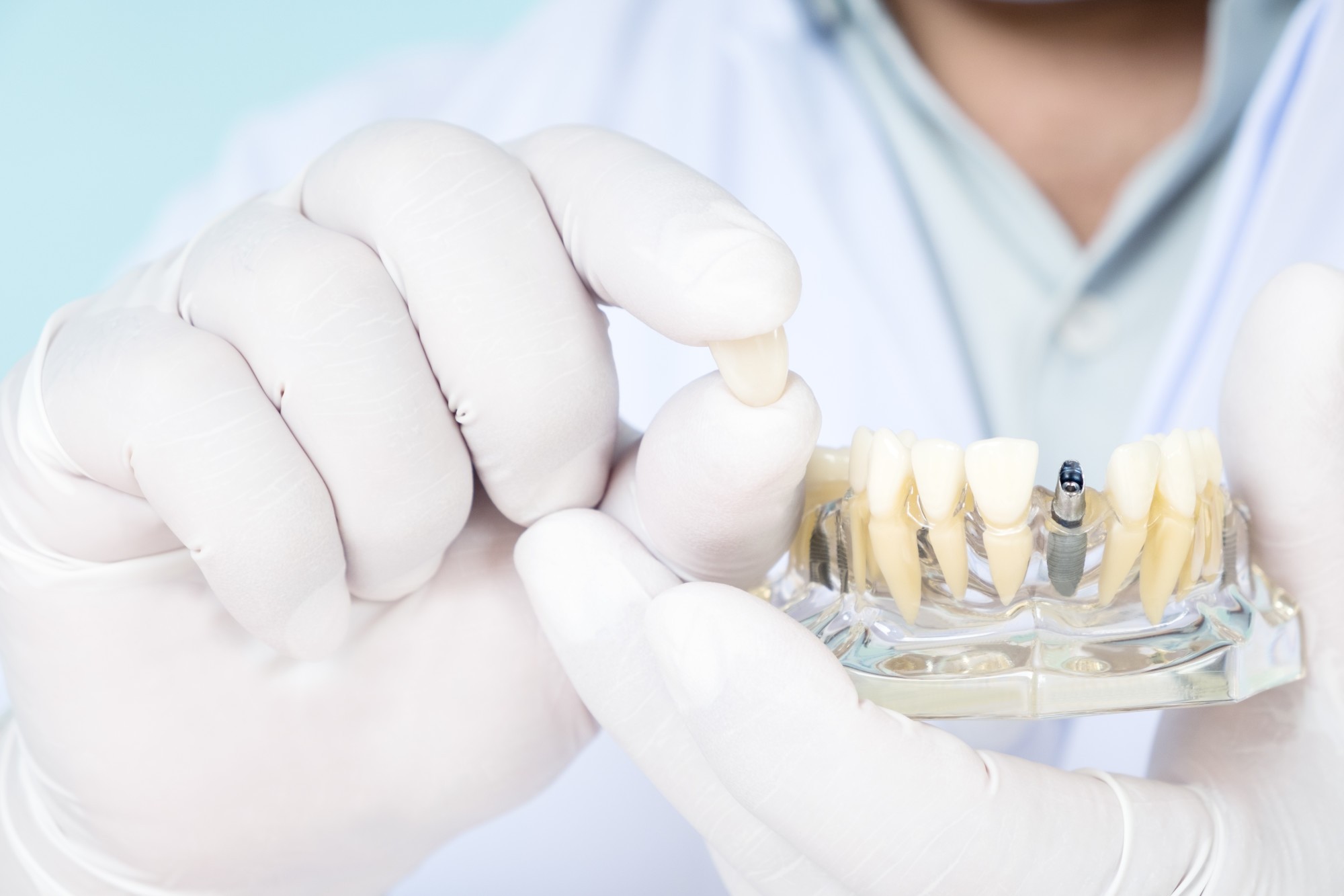 implant-supported dentures