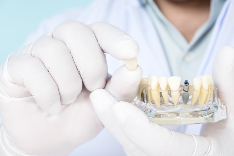 implant-supported dentures