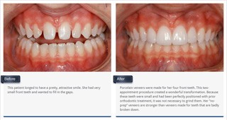 thumb_porcelain_veneers